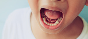 Tongue Tie Release Treatment Specialist Near Me in San Francisco, CA Tongue Tie Release Treatment Specialist Near Me in San Francisco, CA